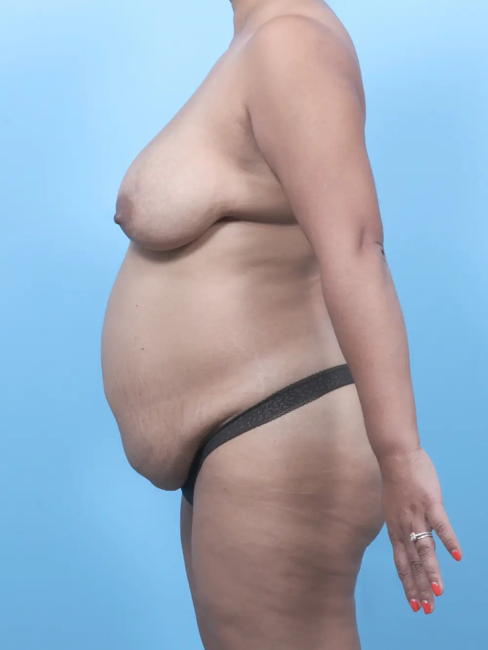Breast Lift/Reduction w/o Implants Patient Photo - Case 58534 - before view-2