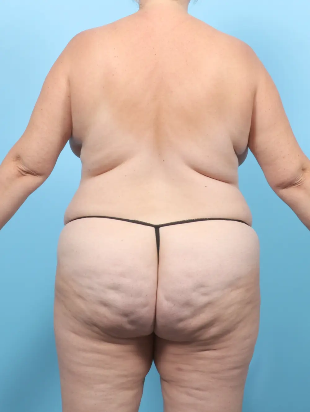 Breast Lift/Reduction with Implants Patient Photo - Case 58545 - before view-3