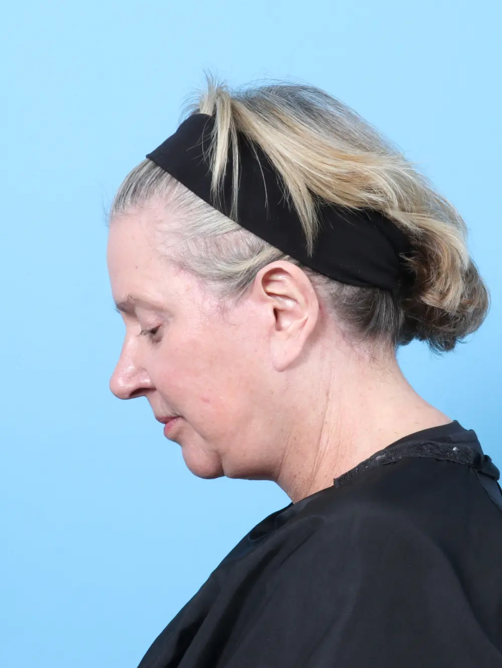 Eyelid Surgery Patient Photo - Case 58564 - after view-3