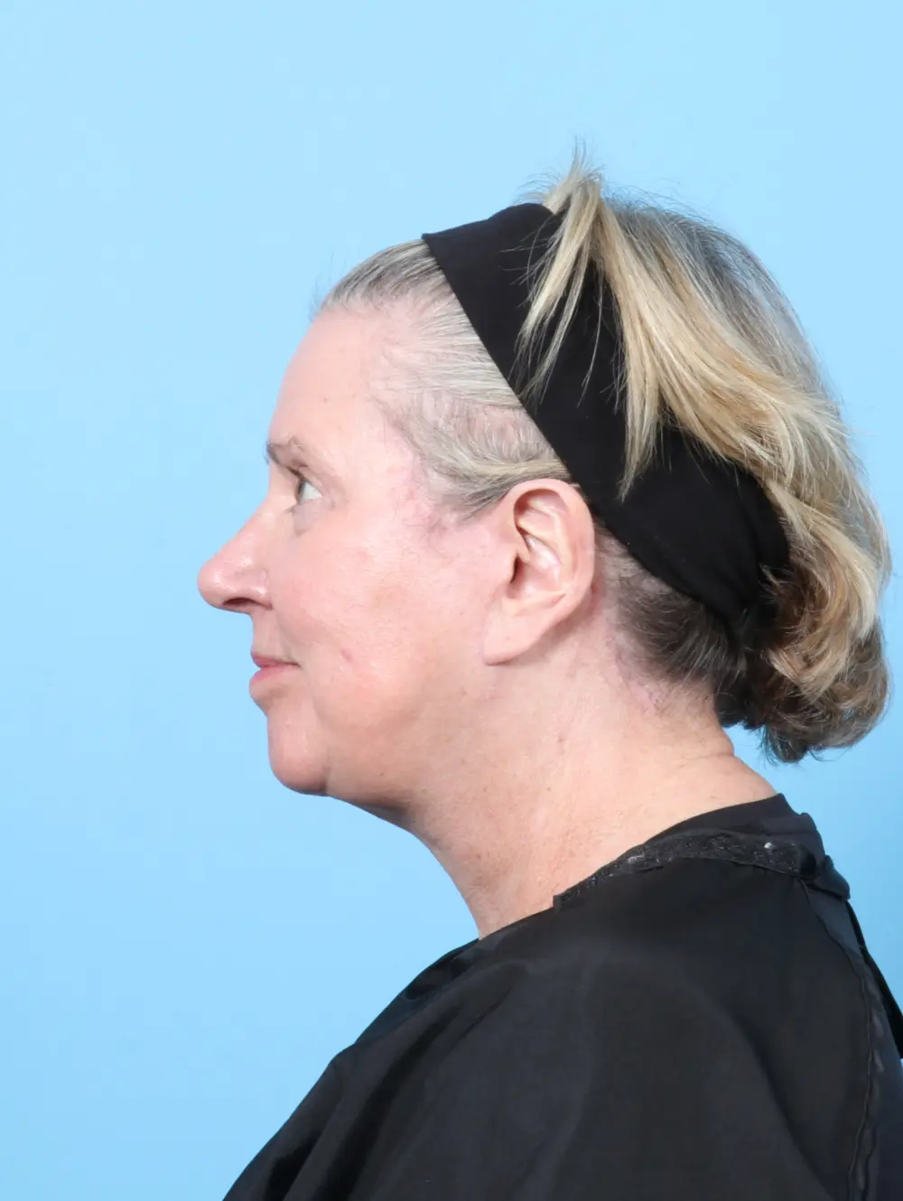 Eyelid Surgery Patient Photo - Case 58564 - after view-2