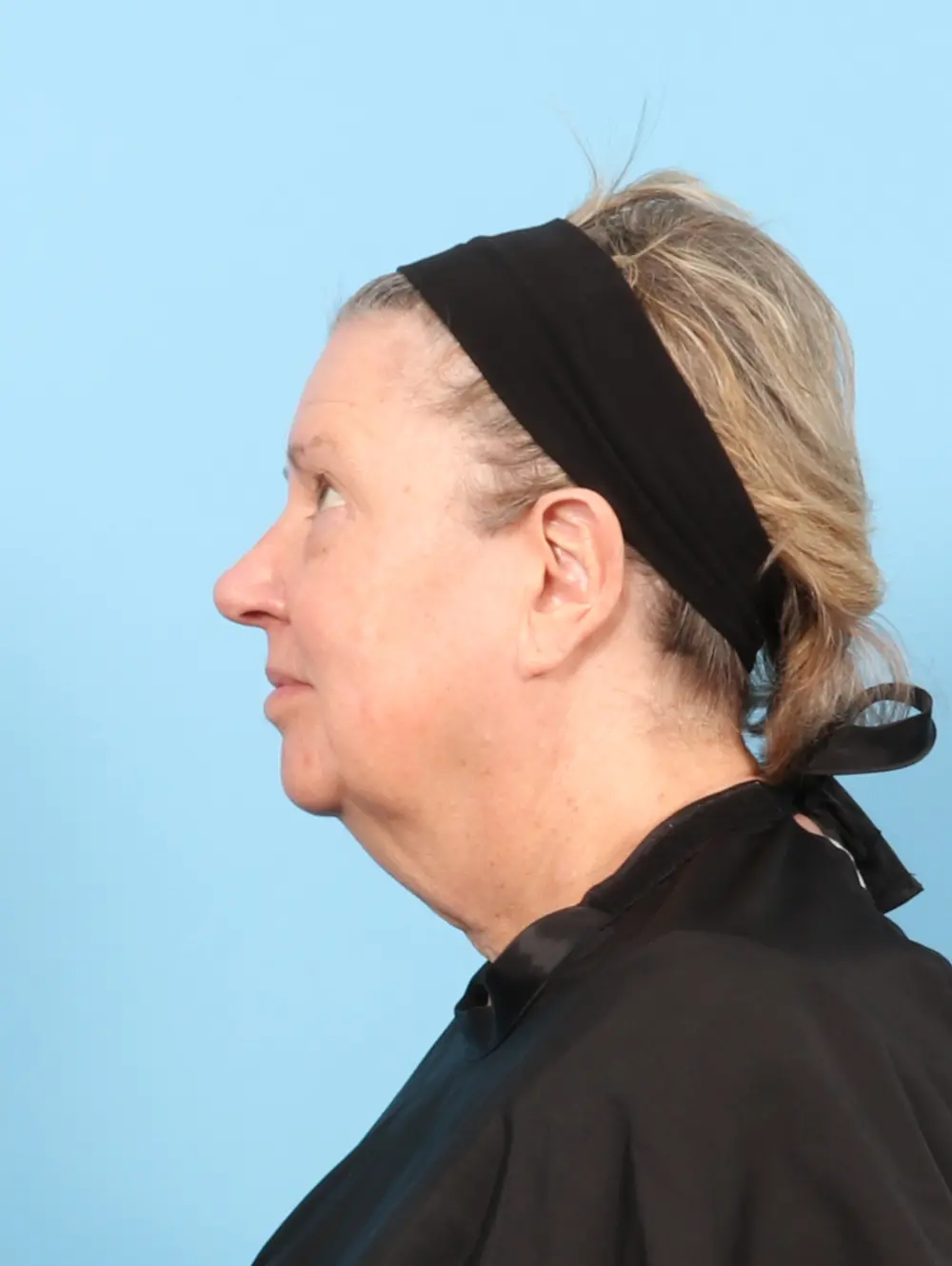 Eyelid Surgery Patient Photo - Case 58564 - before view-2