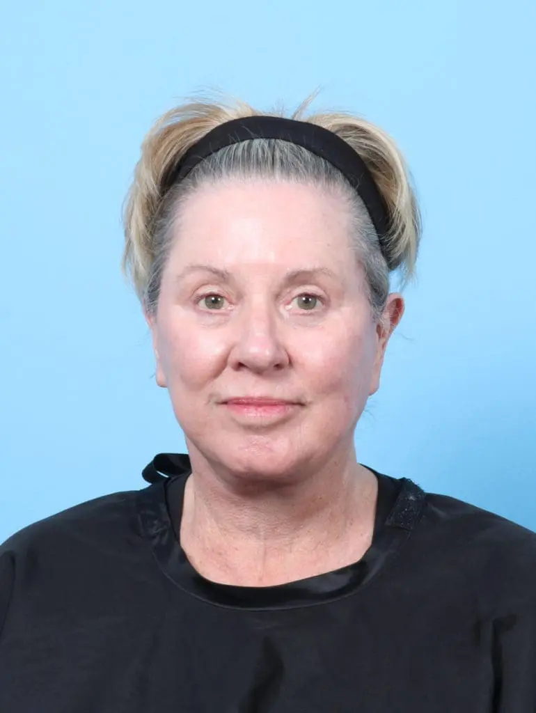 Eyelid Surgery - Case 58564 - After