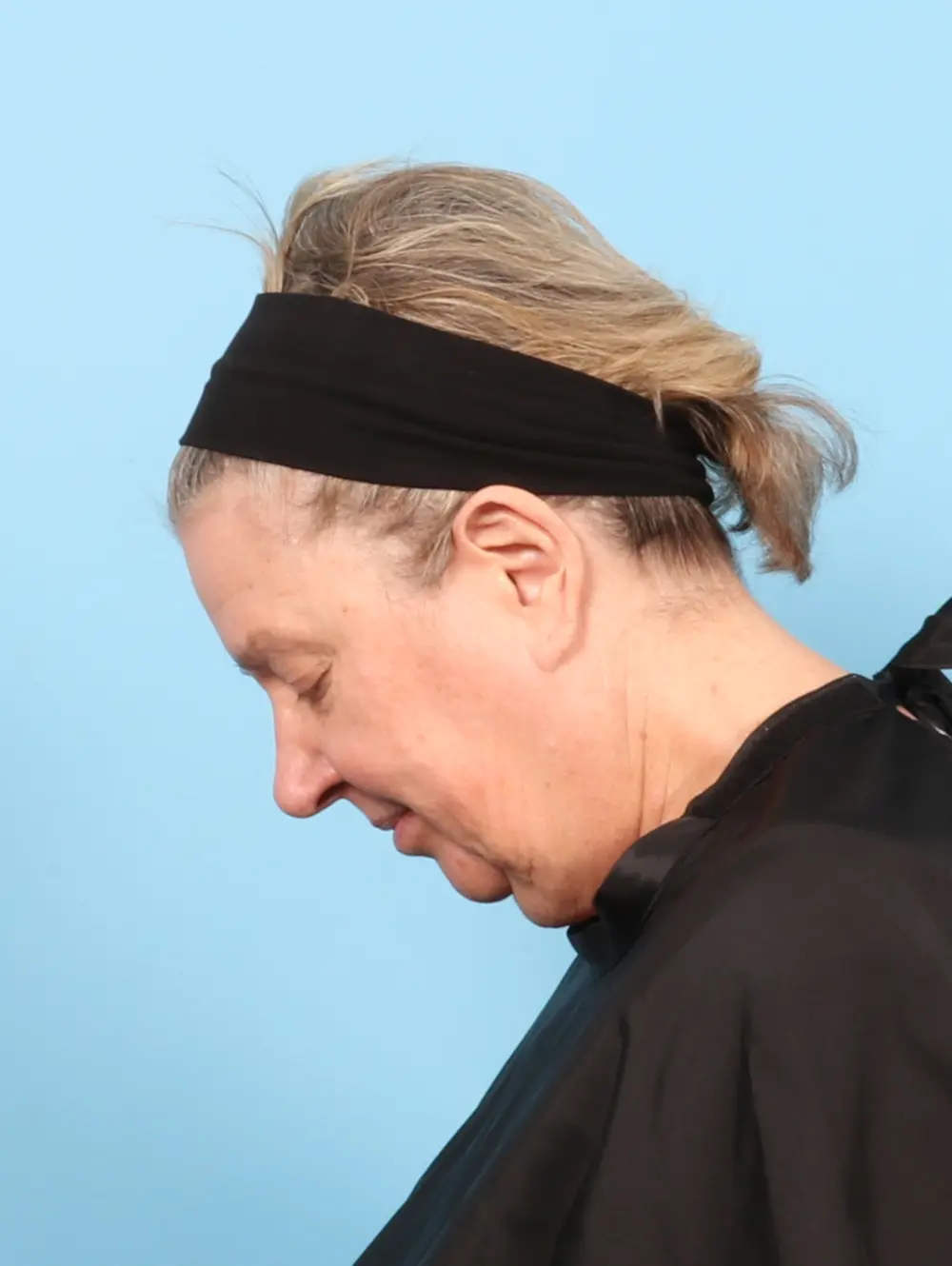 Eyelid Surgery Patient Photo - Case 58564 - before view-3