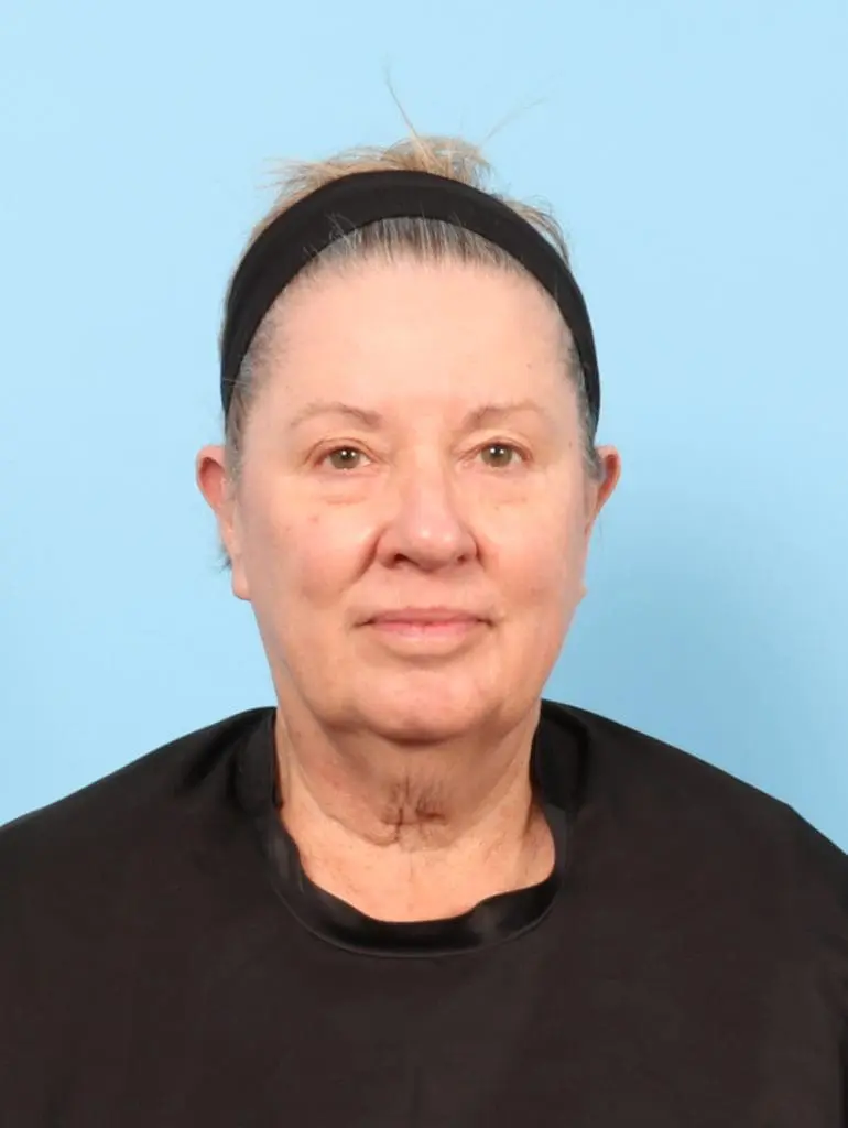 Eyelid Surgery - Case 58564 - Before