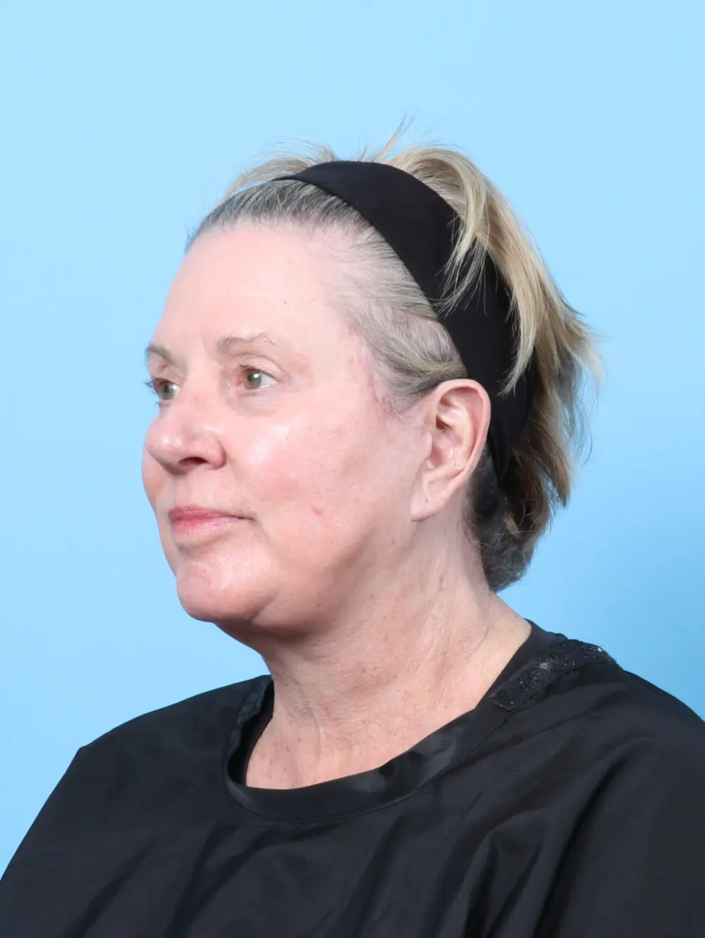 Eyelid Surgery Patient Photo - Case 58564 - after view-1