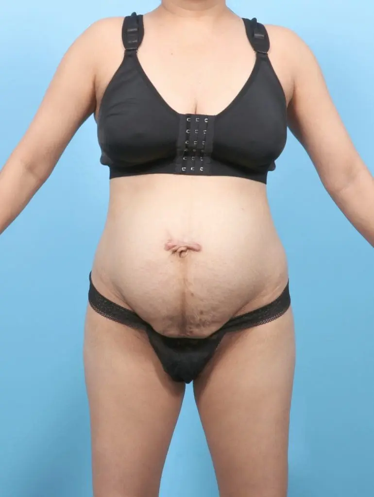 Tummy Tuck - Case 58575 - Before