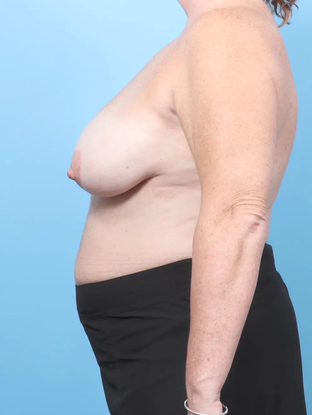 Breast Lift/Reduction with Implants Patient Photo - Case 58599 - before view-2