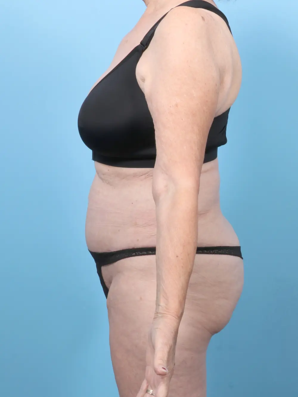 Tummy Tuck Patient Photo - Case 58607 - after view-2