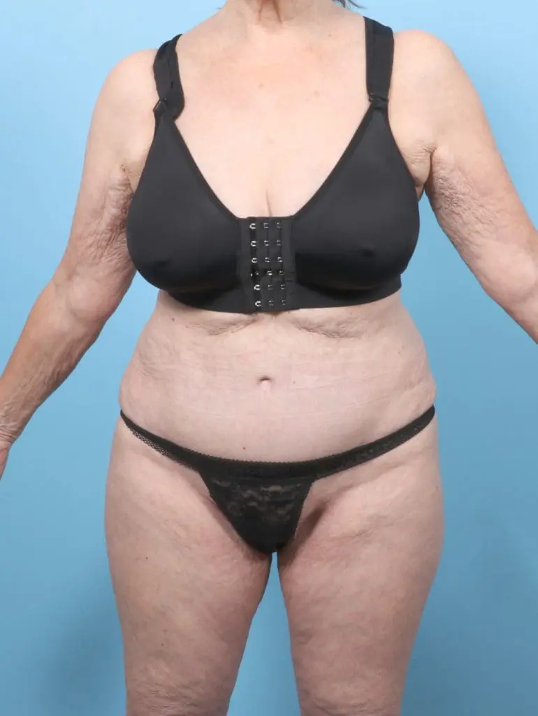 Tummy Tuck - Case 58607 - After