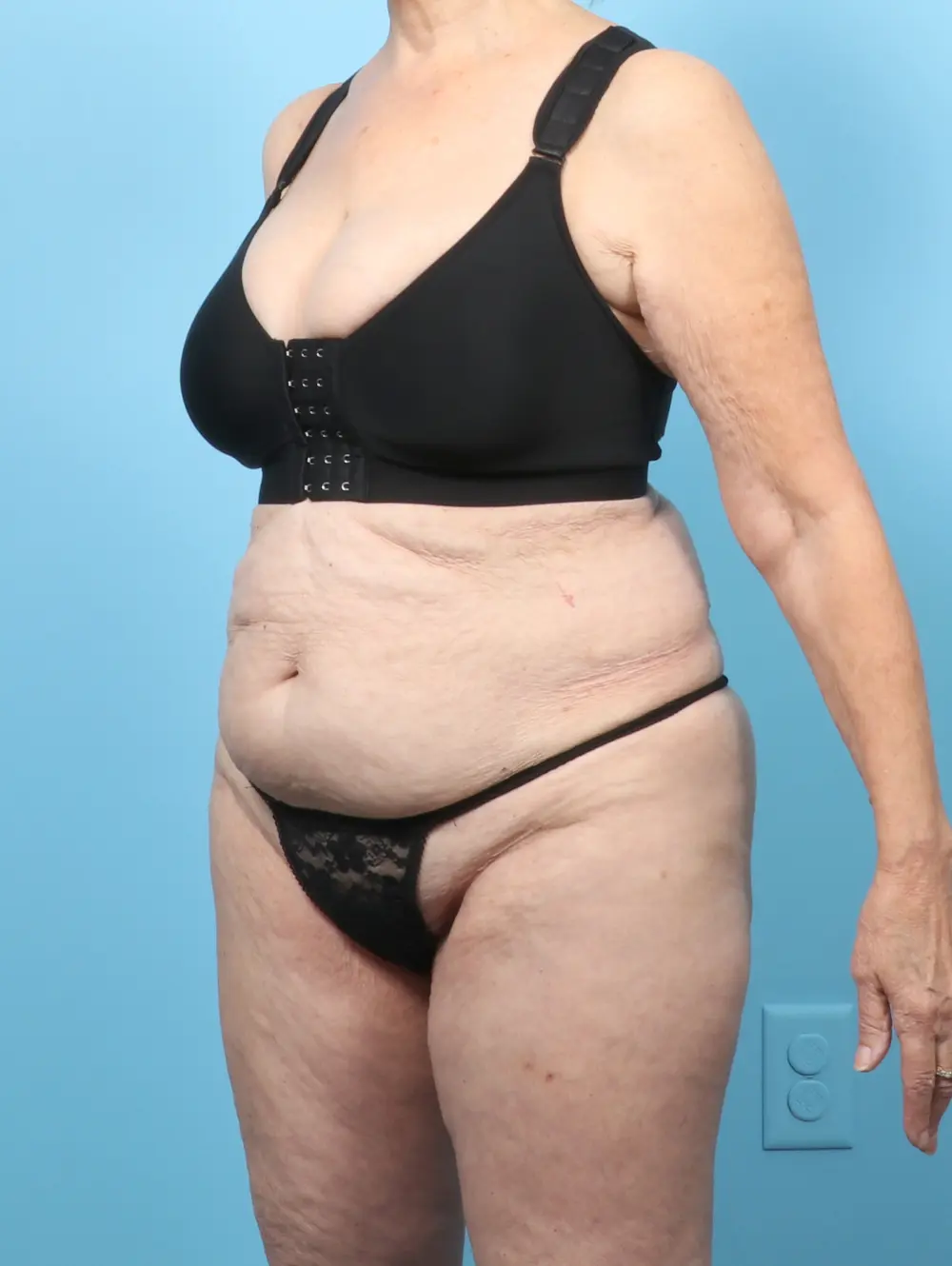 Tummy Tuck Patient Photo - Case 58607 - before view-1