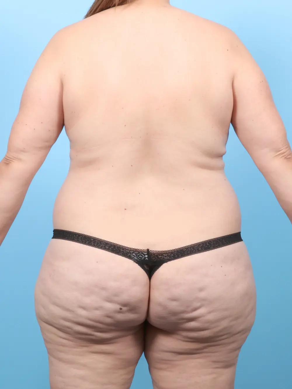 Tummy Tuck Patient Photo - Case 58678 - before view-3