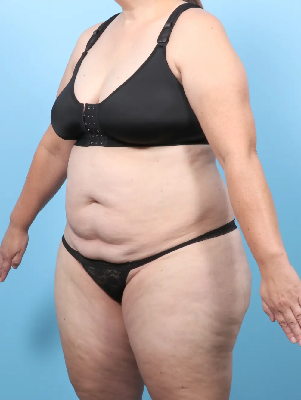 Tummy Tuck Patient Photo - Case 58678 - before view-1