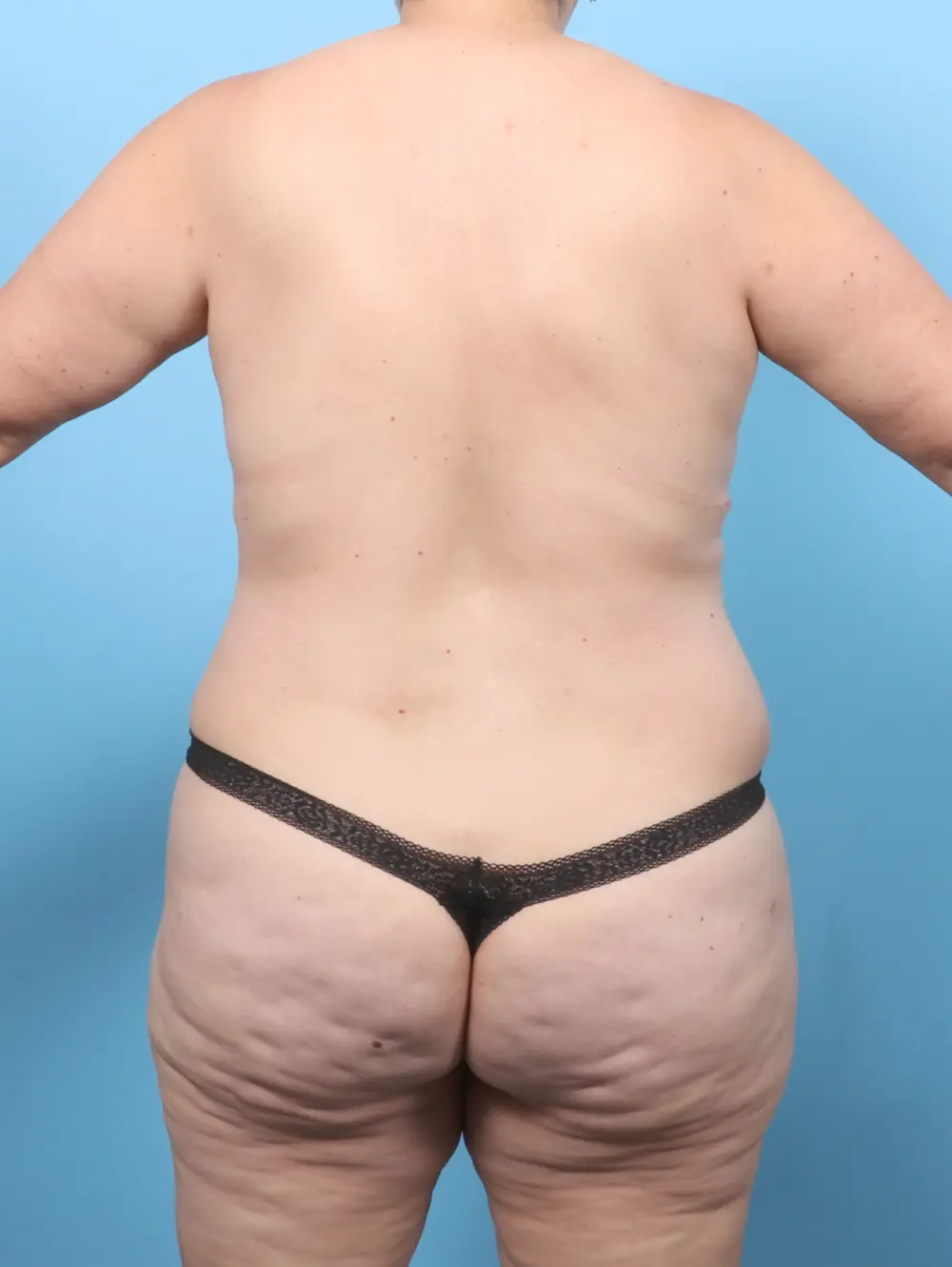 Tummy Tuck Patient Photo - Case 58678 - after view-3