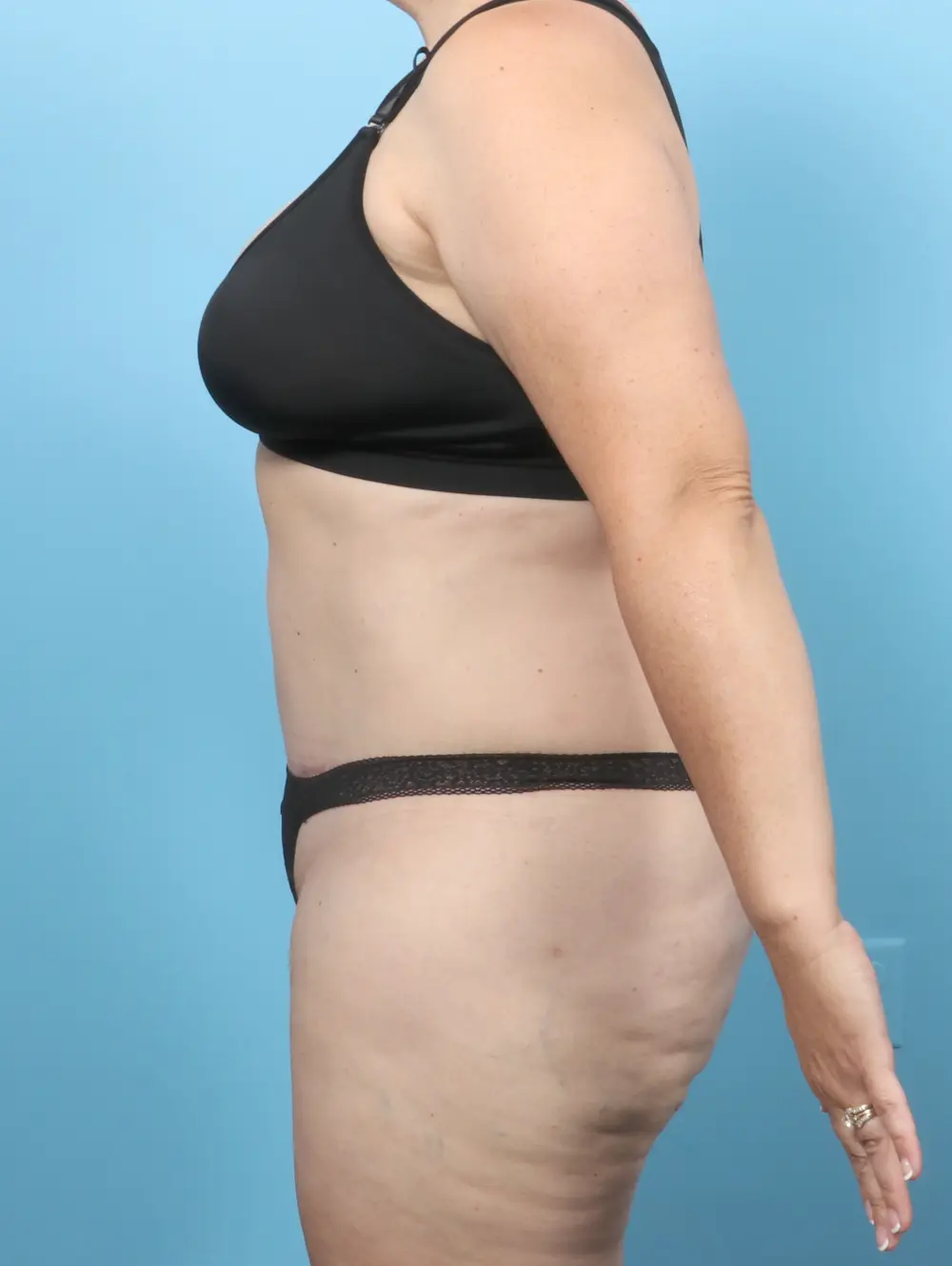 Tummy Tuck Patient Photo - Case 58678 - after view-2