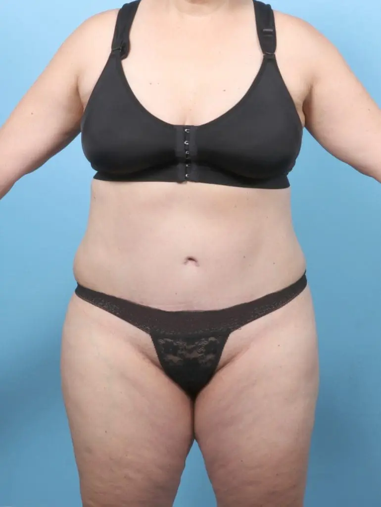 Tummy Tuck - Case 58678 - After