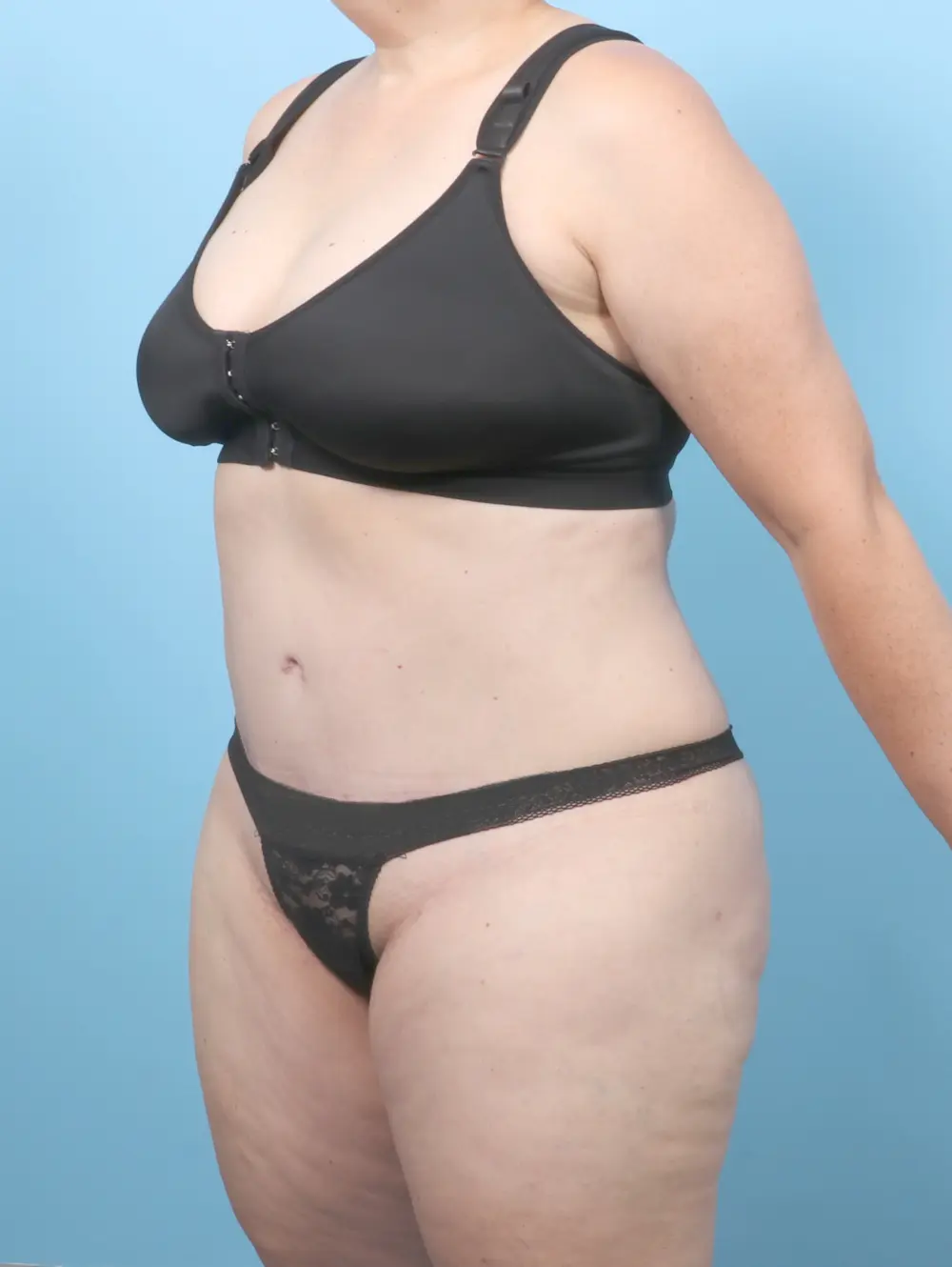 Tummy Tuck Patient Photo - Case 58678 - after view-1