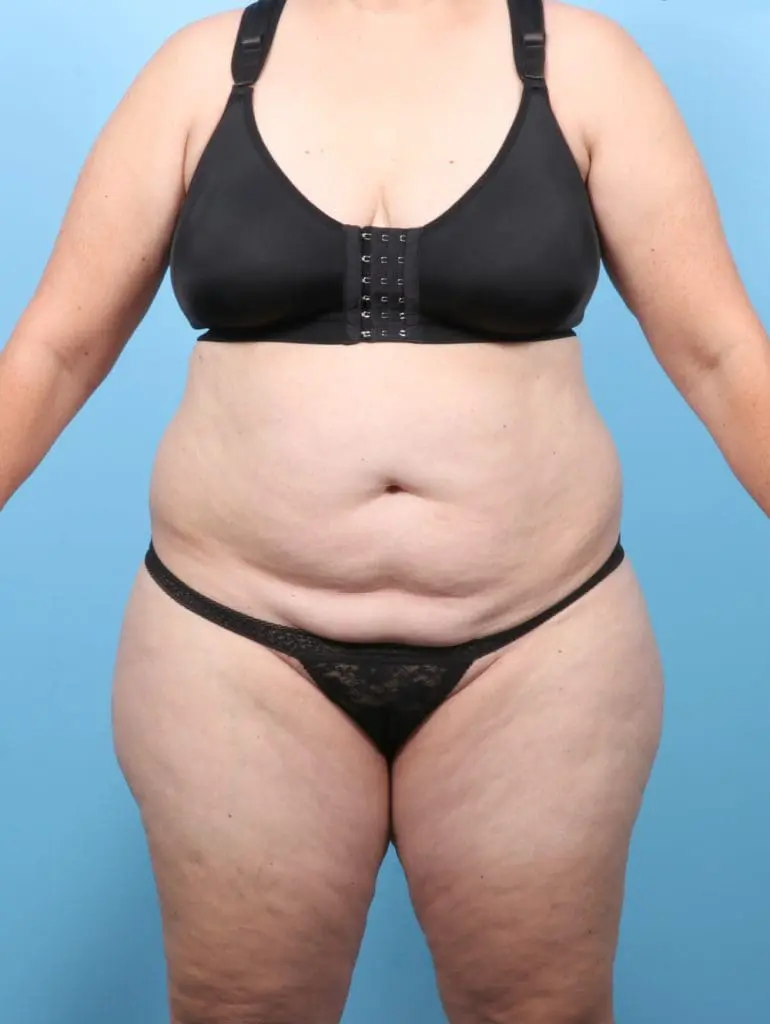 Tummy Tuck - Case 58678 - Before