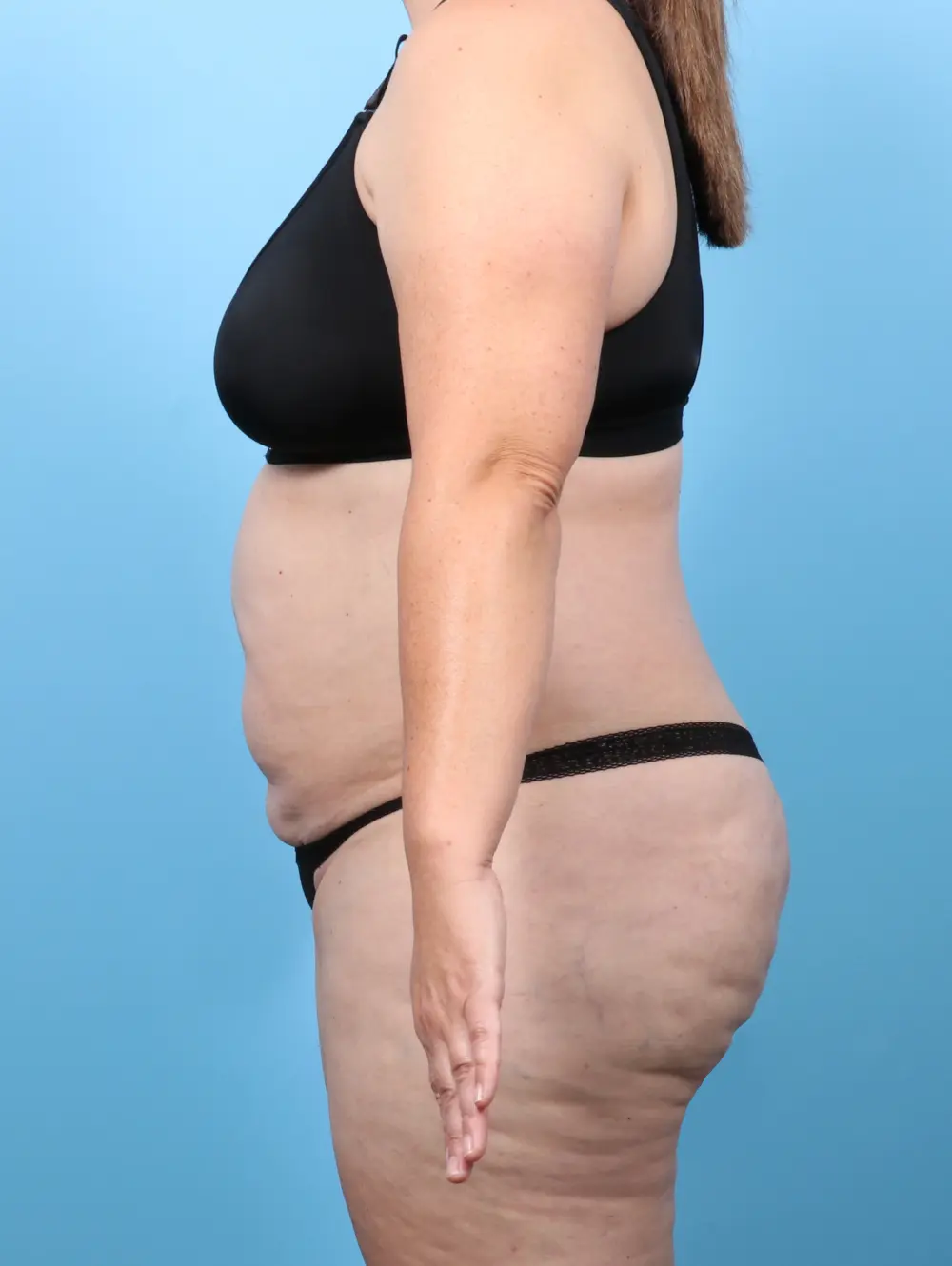 Tummy Tuck Patient Photo - Case 58678 - before view-2