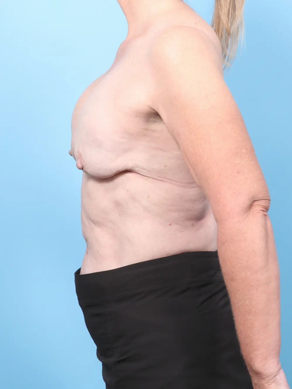 Breast Implant Revision Patient Photo - Case 58690 - before view-2