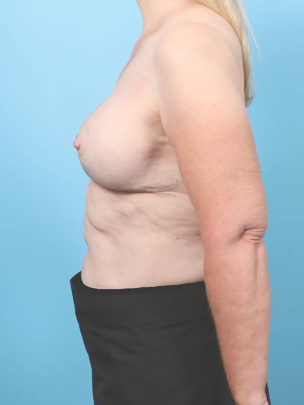 Breast Implant Revision Patient Photo - Case 58690 - after view-2