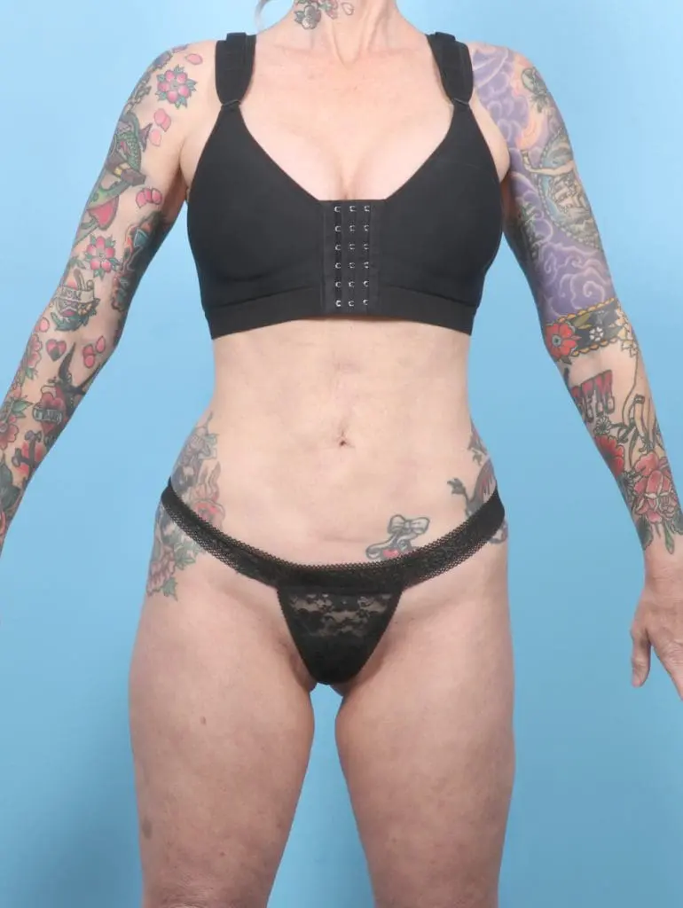 Tummy Tuck - Case 58707 - Before