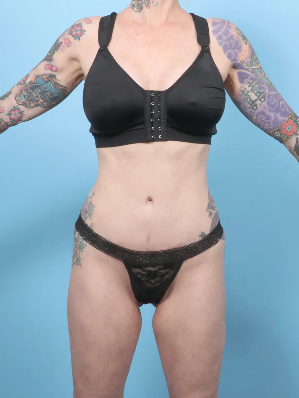 Tummy Tuck Patient Photo - Case 58707 - after view