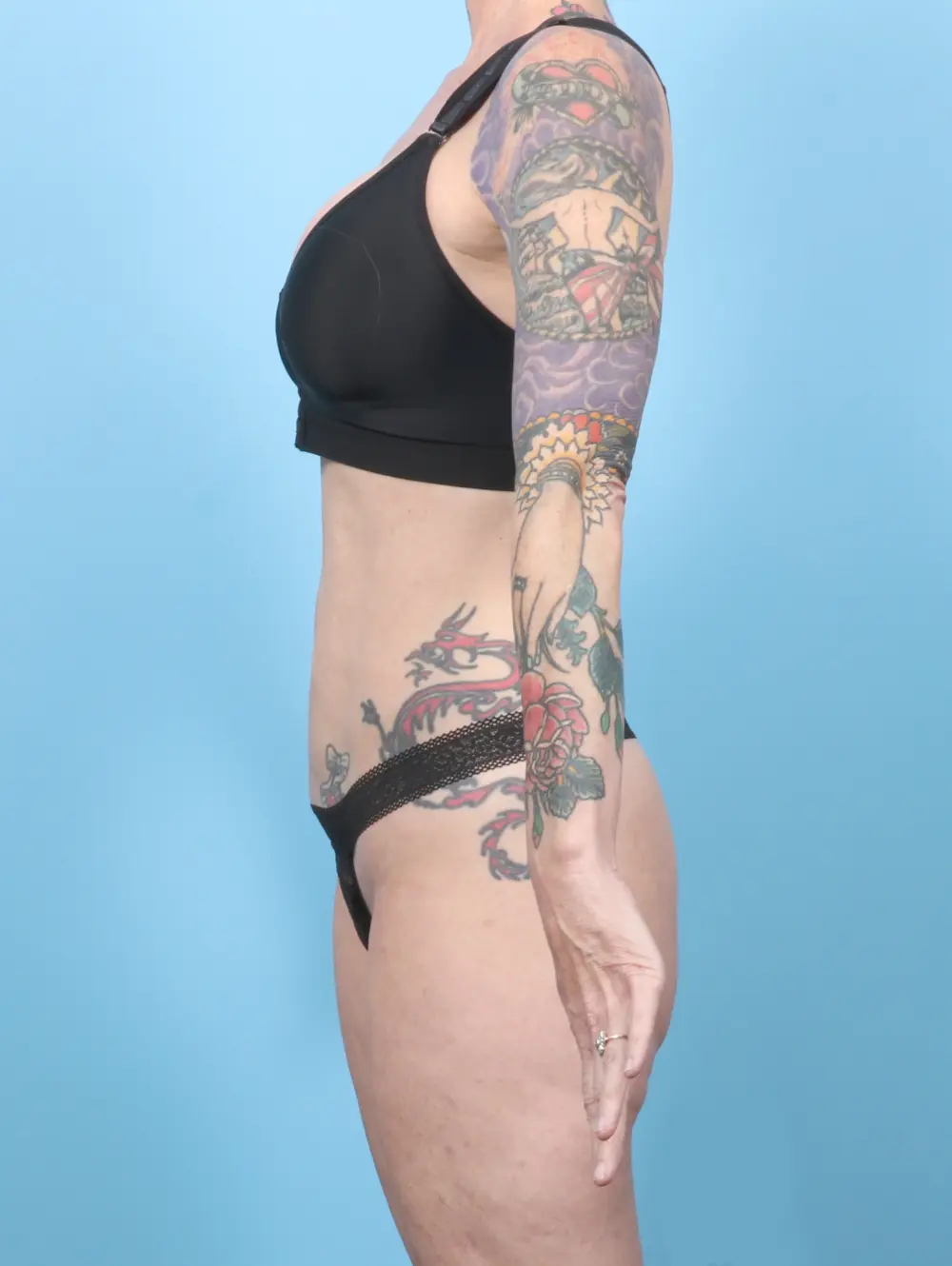 Tummy Tuck Patient Photo - Case 58707 - before view-2