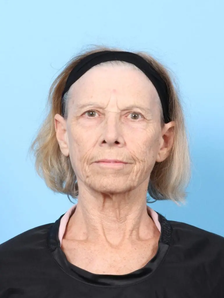 Brow Lift - Case 58751 - Before