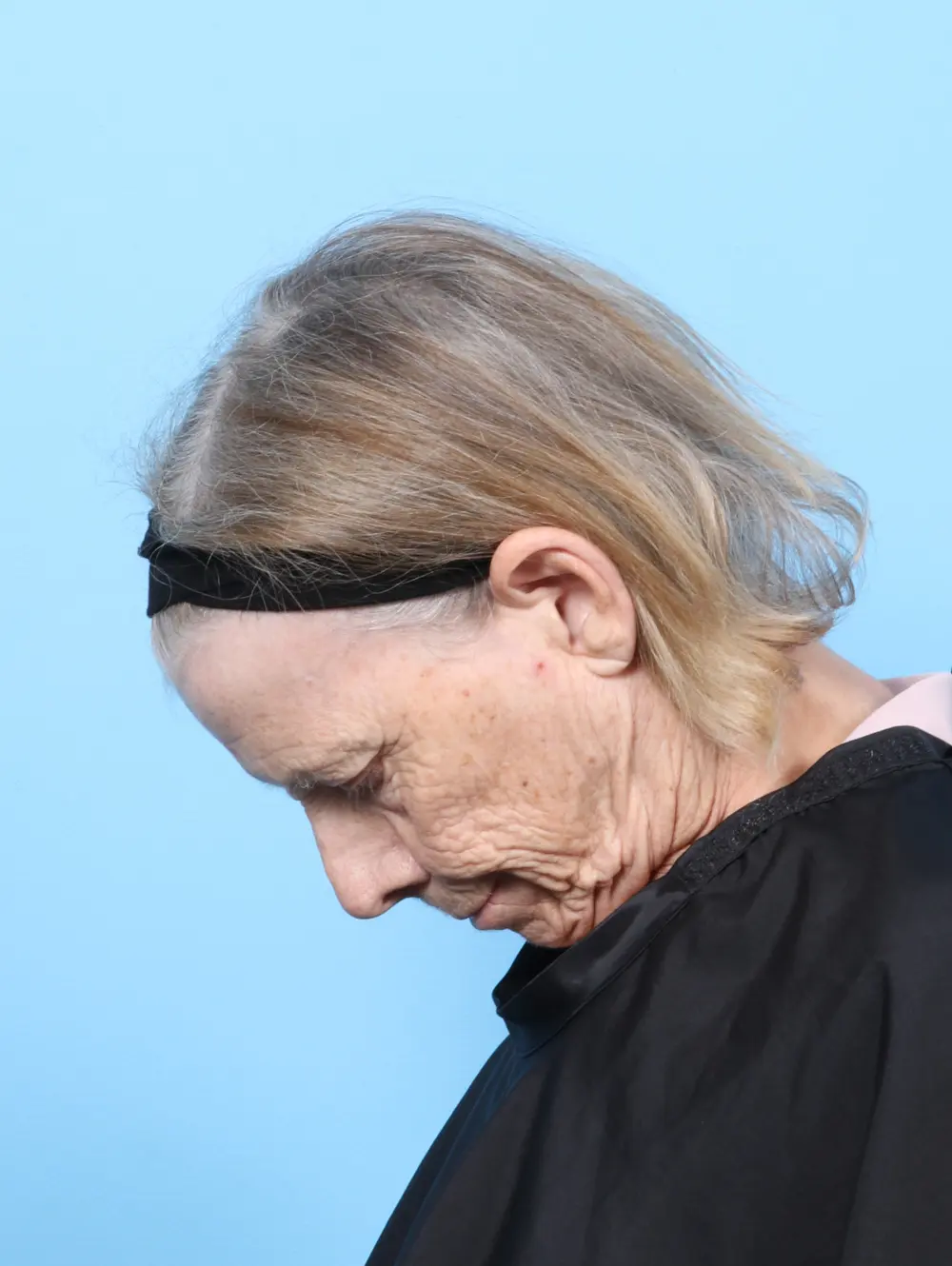 Brow Lift Patient Photo - Case 58751 - before view-3