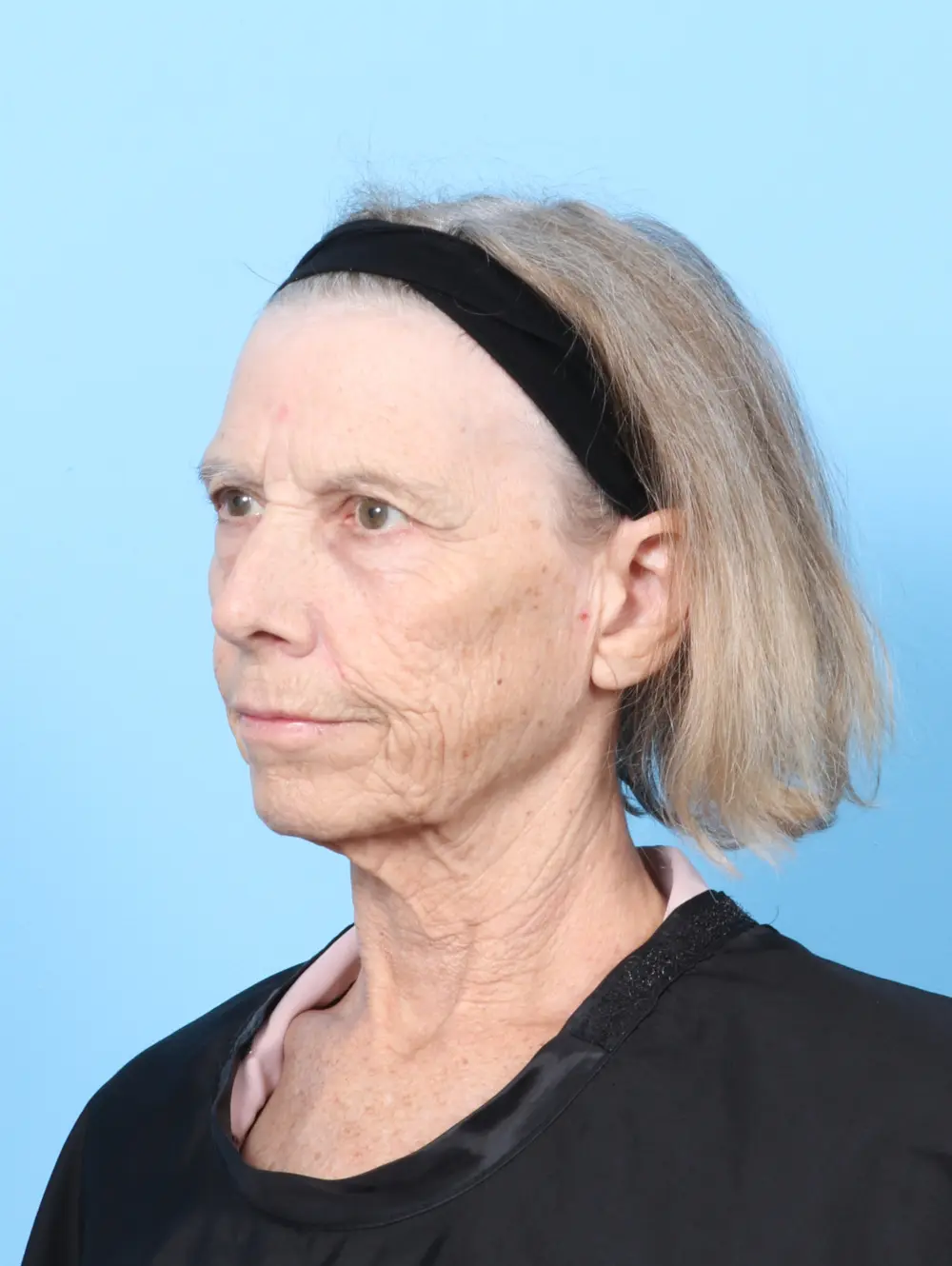 Brow Lift Patient Photo - Case 58751 - before view-1