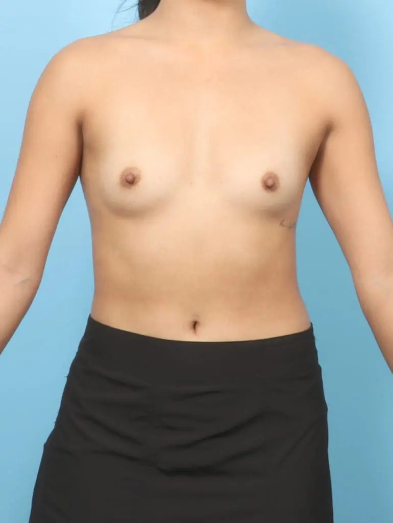 Breast Augmentation - Case 58779 - Before