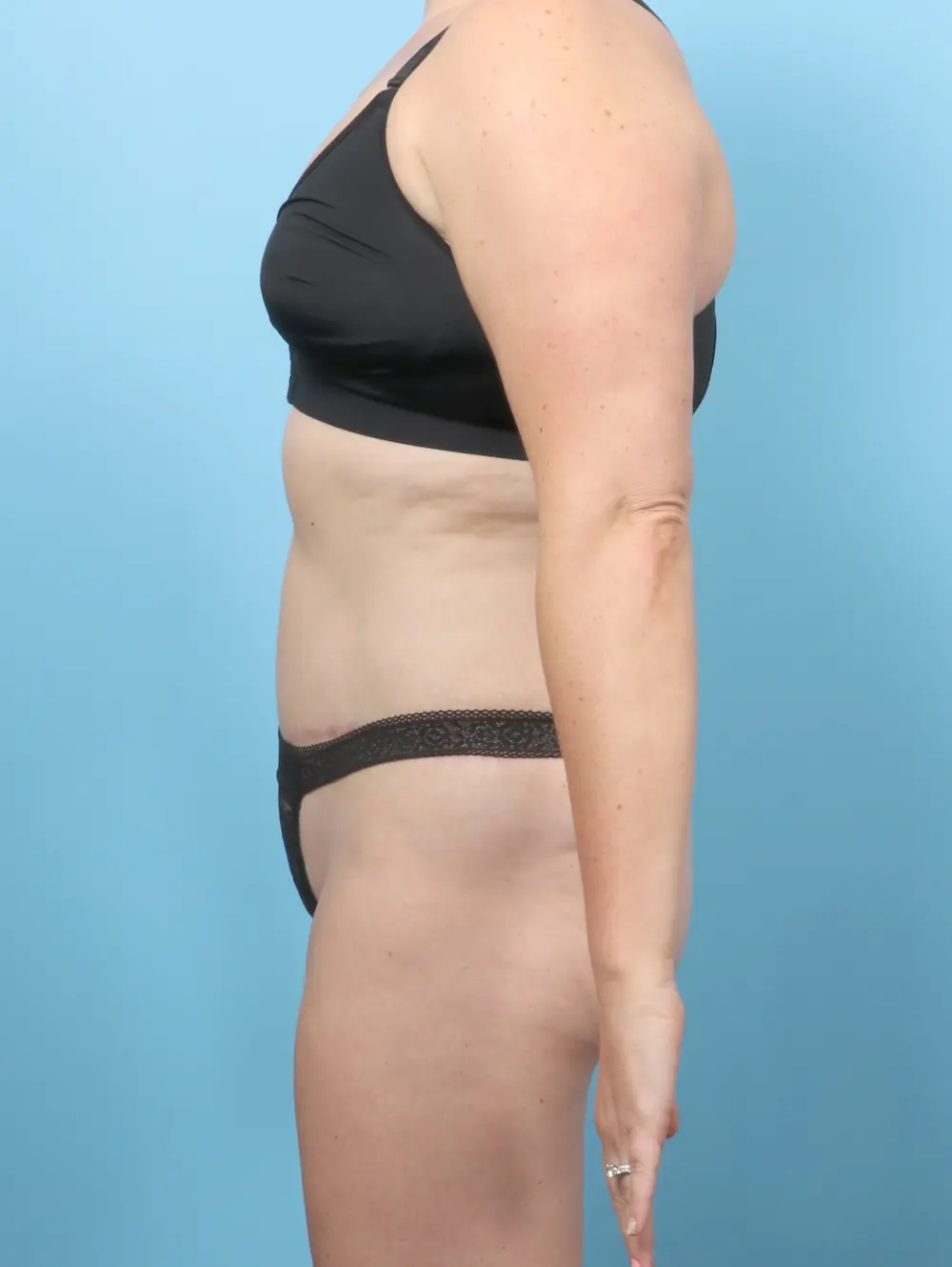 Tummy Tuck Patient Photo - Case 58787 - after view-2