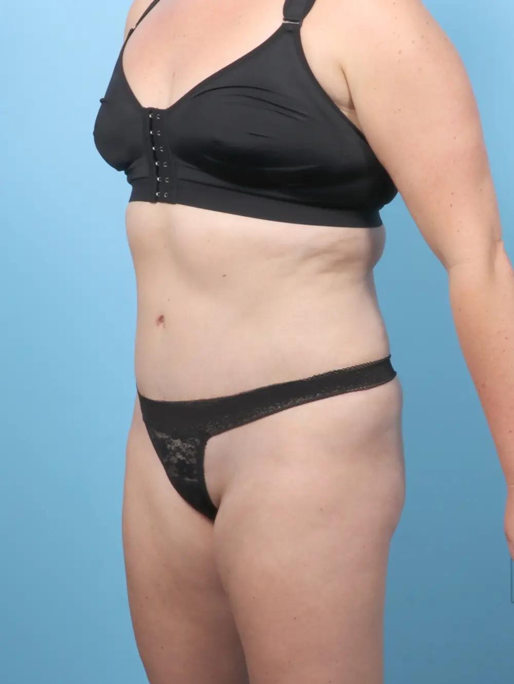 Tummy Tuck Patient Photo - Case 58787 - after view-1