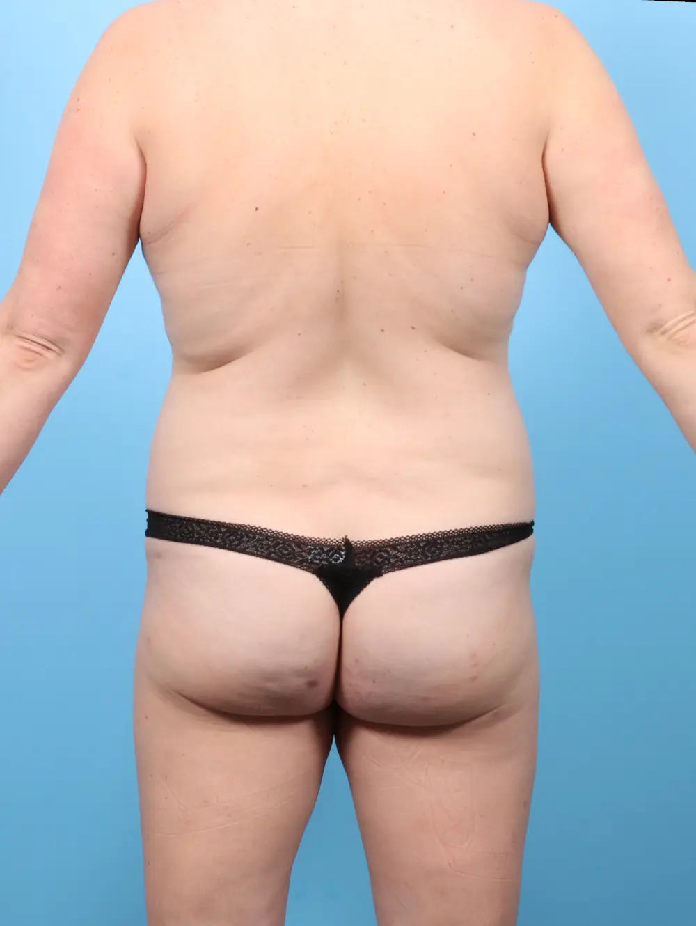 Tummy Tuck Patient Photo - Case 58787 - before view-3