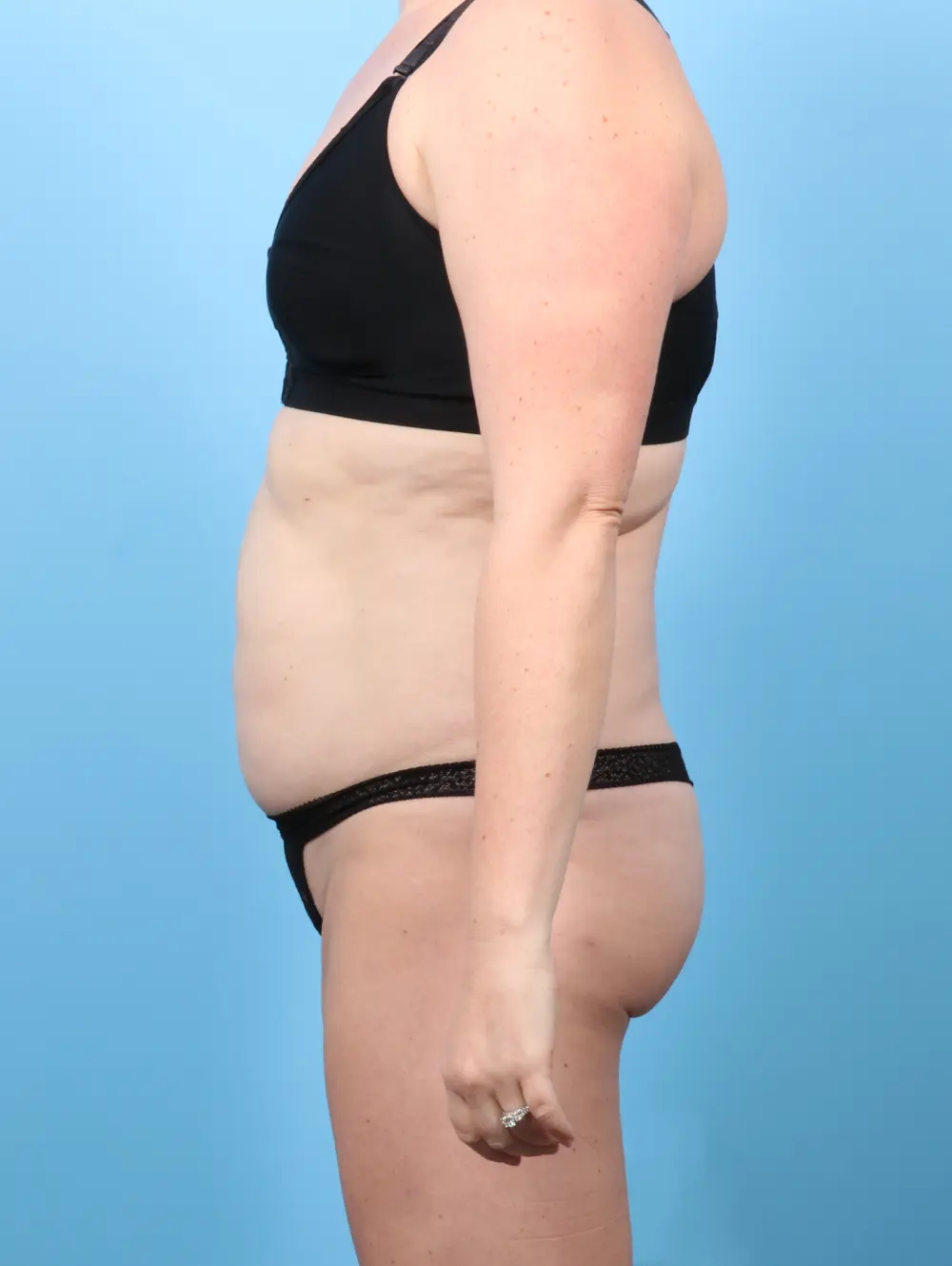 Tummy Tuck Patient Photo - Case 58787 - before view-2