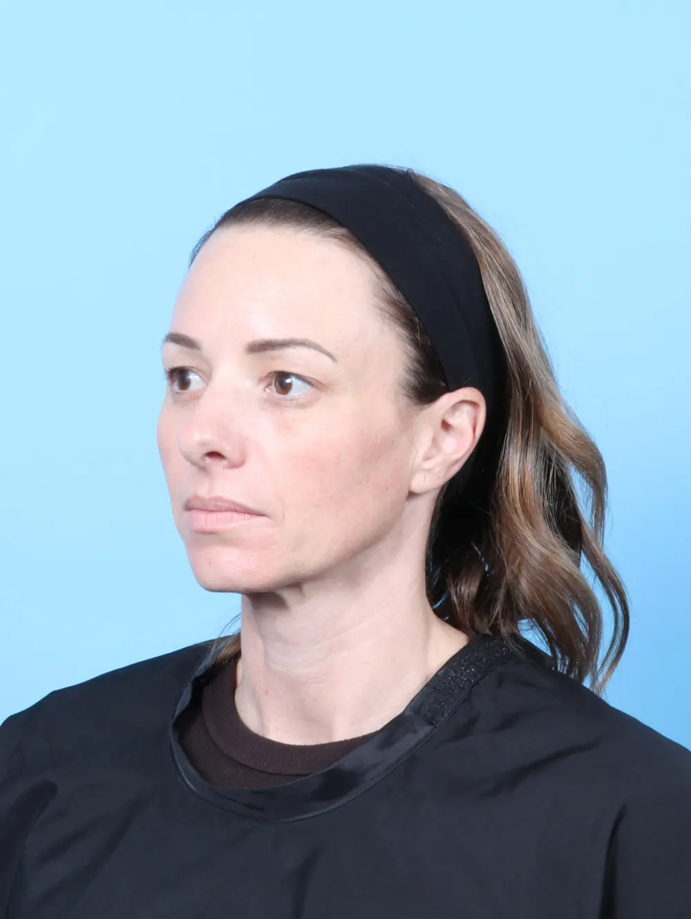 Eyelid Surgery Patient Photo - Case 58809 - before view-1