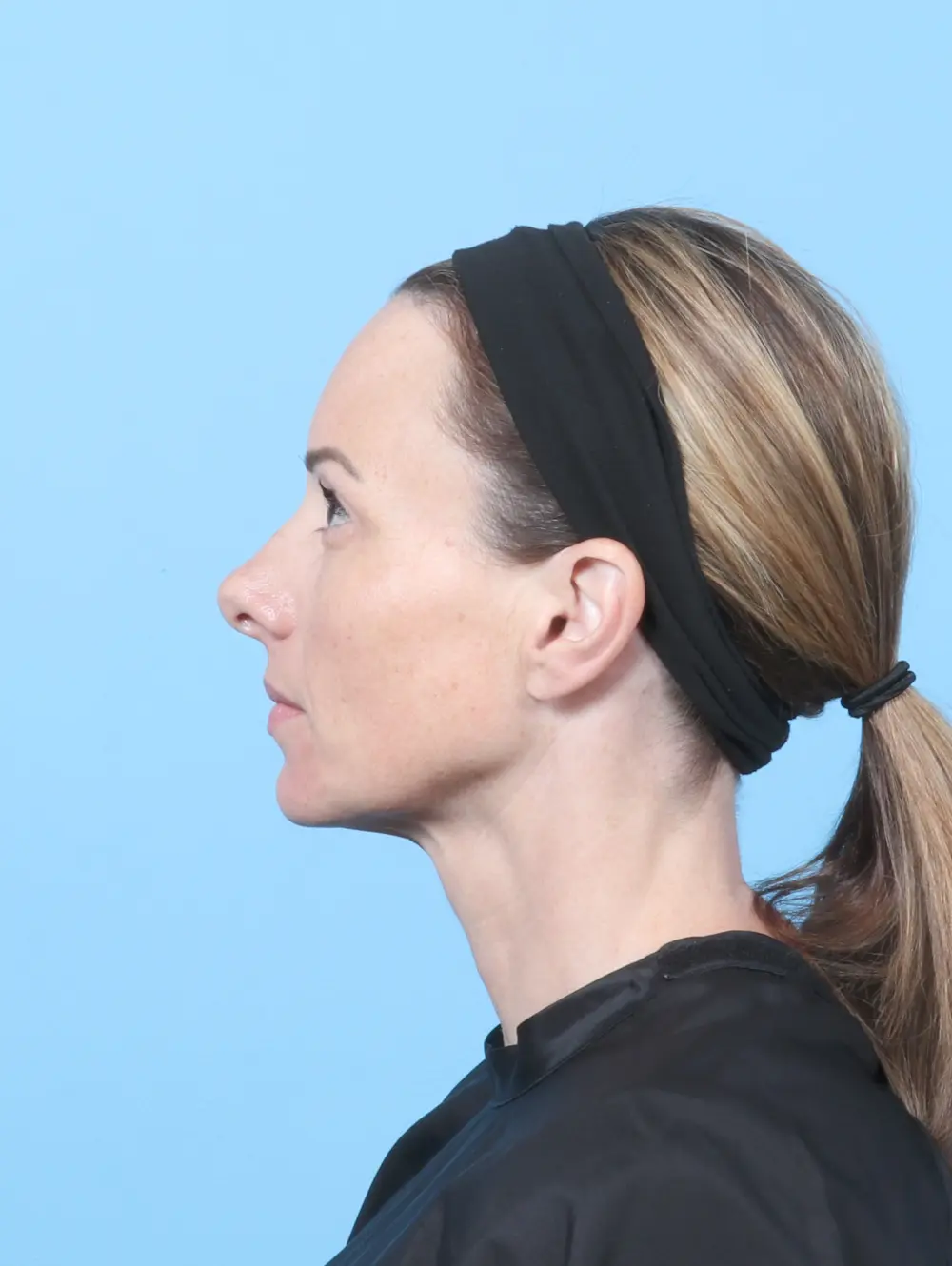 Eyelid Surgery Patient Photo - Case 58809 - after view-2