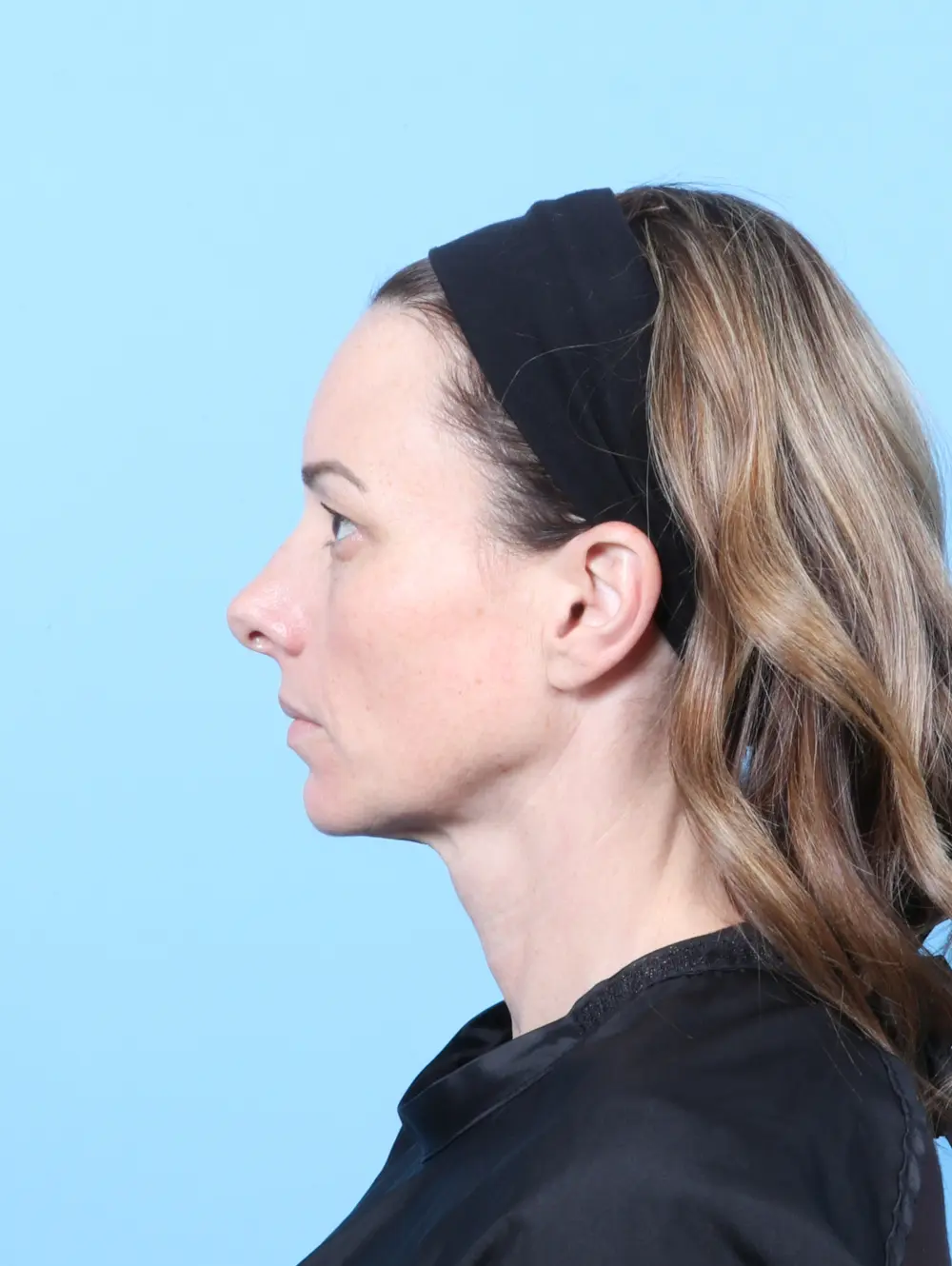 Eyelid Surgery Patient Photo - Case 58809 - before view-2