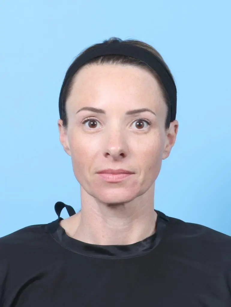 Eyelid Surgery - Case 58809 - After