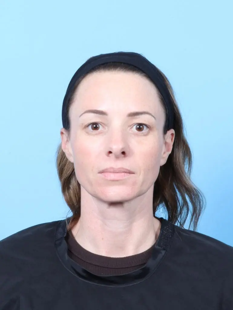 Eyelid Surgery - Case 58809 - Before