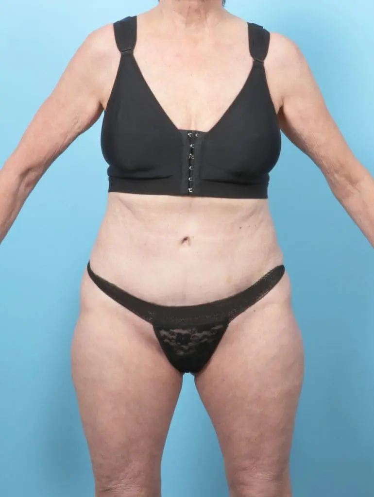 Tummy Tuck - Case 58852 - After