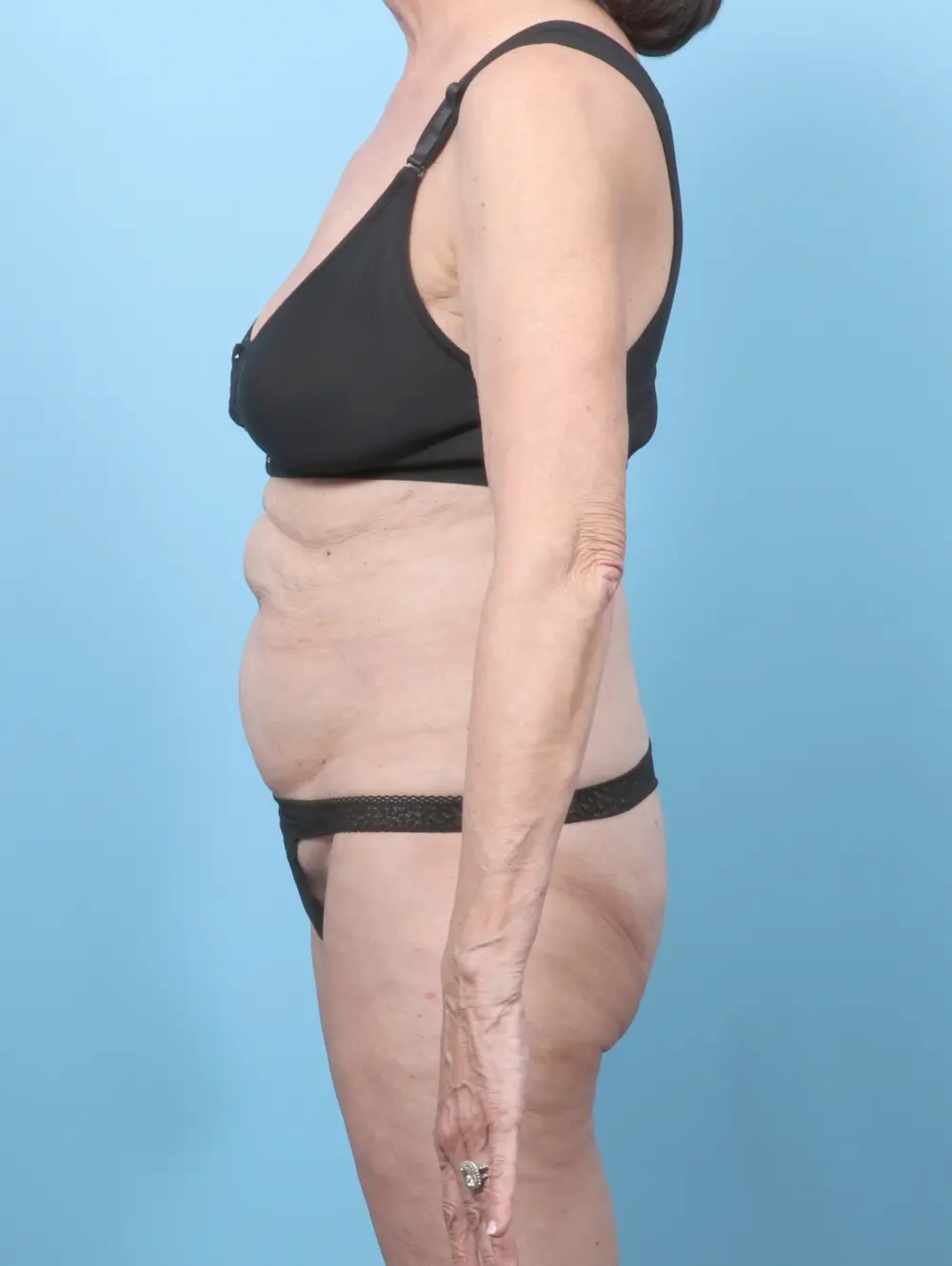 Tummy Tuck Patient Photo - Case 58852 - before view-2