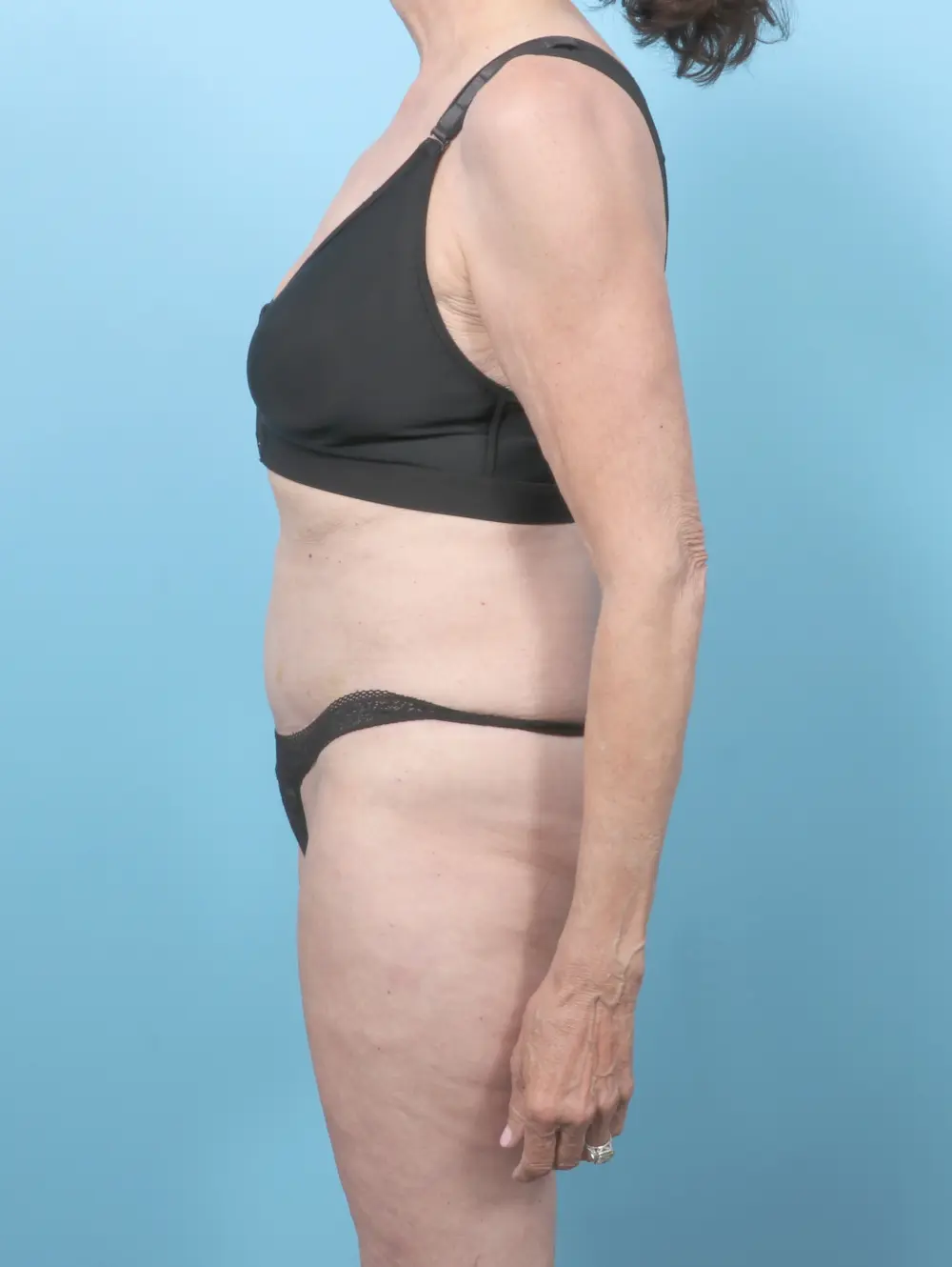 Tummy Tuck Patient Photo - Case 58852 - after view-2
