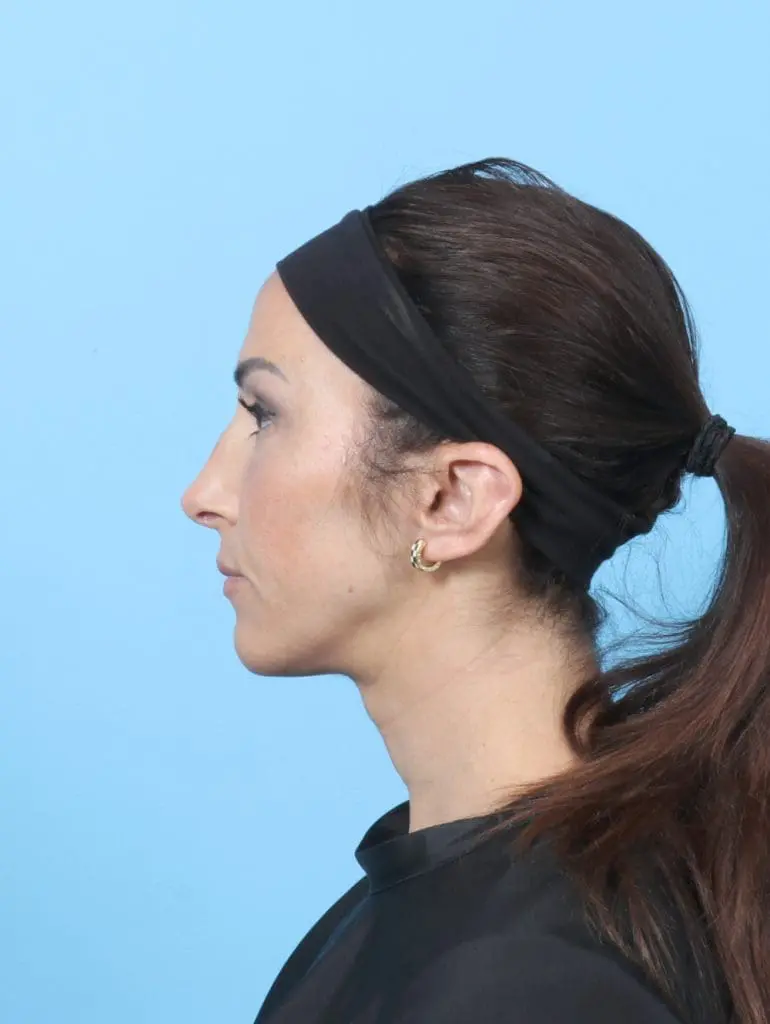 Rhinoplasty - Case 58941 - After