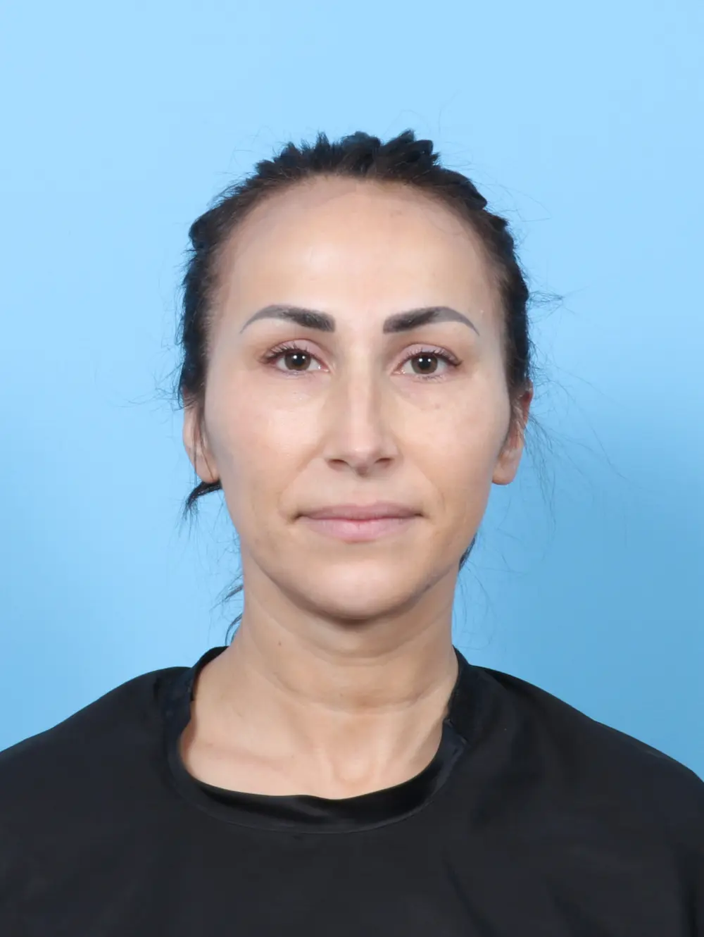 Rhinoplasty Patient Photo - Case 58941 - before view-2
