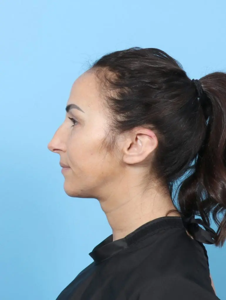 Rhinoplasty - Case 58941 - Before