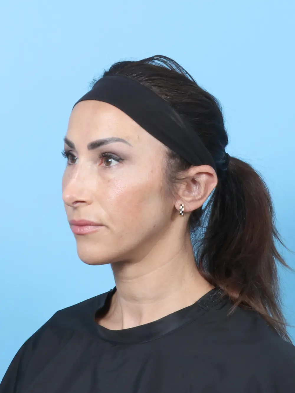 Rhinoplasty Patient Photo - Case 58941 - after view-1