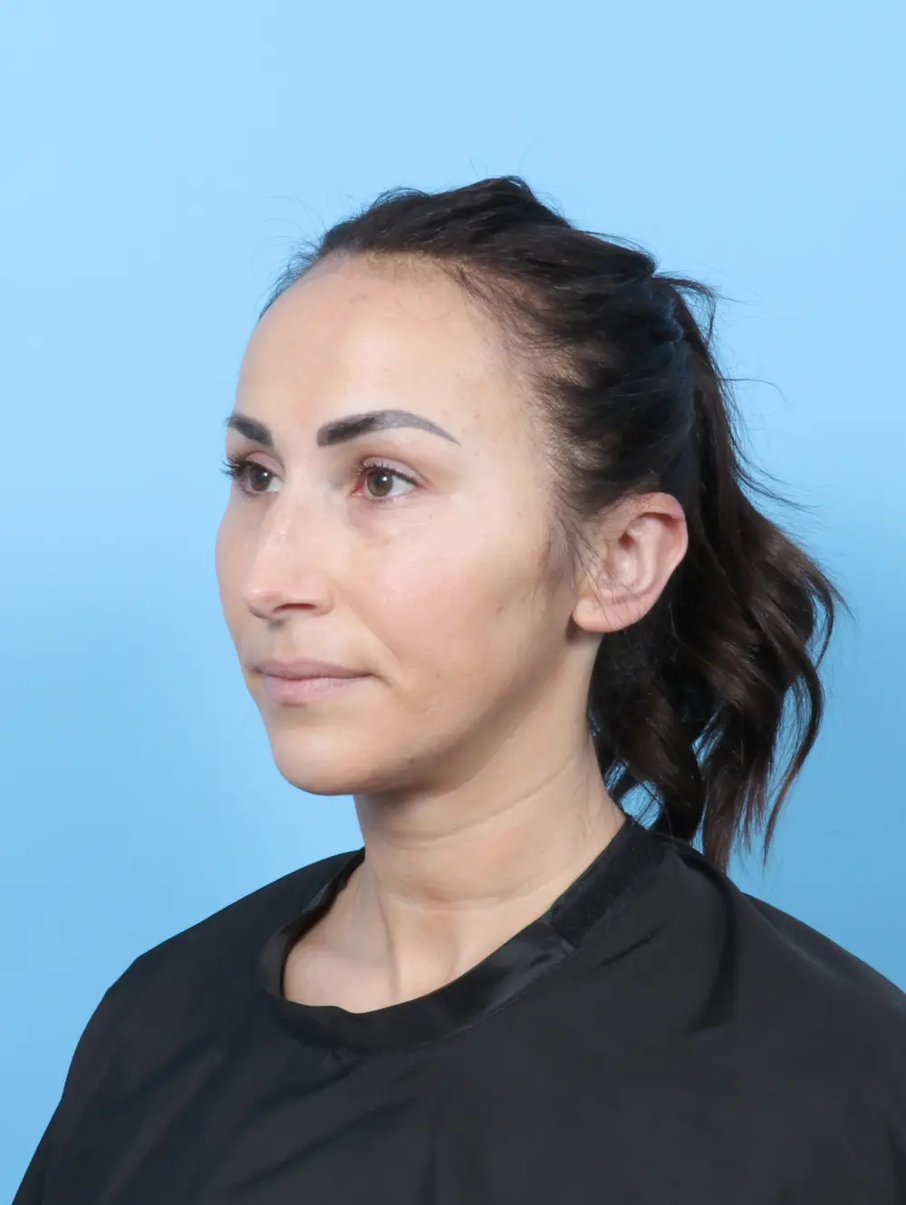 Rhinoplasty Patient Photo - Case 58941 - before view-1