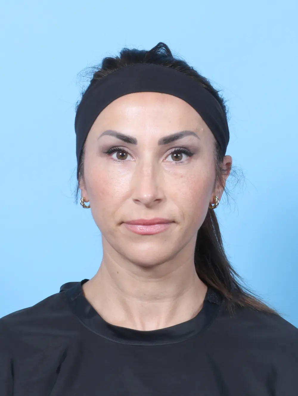 Rhinoplasty Patient Photo - Case 58941 - after view-2