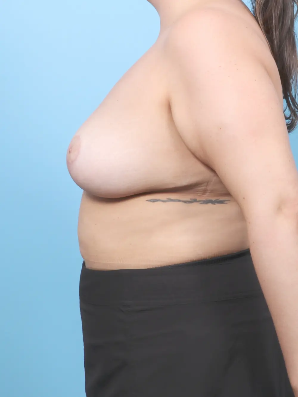 Breast Lift/Reduction w/o Implants Patient Photo - Case 58949 - after view-2